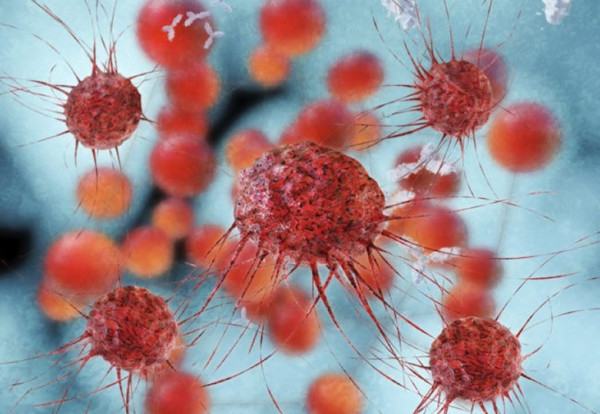 Göğüs, Mesane ve Kolon Kanserinde Risk Altında Mısınız?