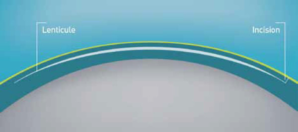 Lentikül Ekstraksiyonu