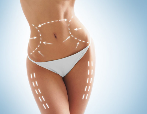 Liposuction uygulaması
