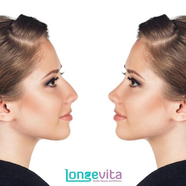Burun estetiği - Longevita