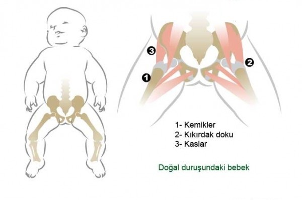 bebek kalça çıkığı